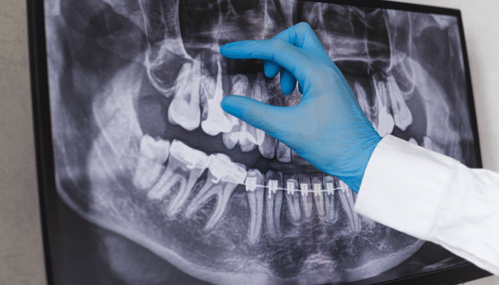 Root Canal XRay
